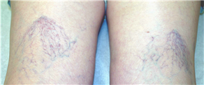 Hate spider veins? Get my advice for spotless and beautiful body