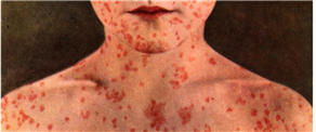 Save your time and money; curing measles without a doc