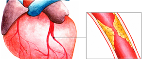 Coronary Artery Spasm – Causes, Symptoms,Diagnosis, Treatments and Management